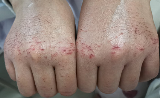 疫情中的手衛生與手部皮膚圖片2